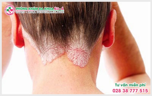 Có rất nhiều người vẫn chưa biết về bệnh vảy nến da đầu như thế nào? Nó rất nguy hiểm. Chính vì thế mà bạn cần phải biết về bệnh vẩy nến trước khi quá muộn.