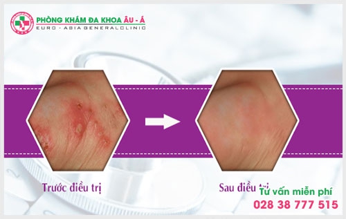 Để hiễu rõ hơn về bệnh ghẻ là gì? Nguyên nhân và cách điều trị hiệu quả thì người bệnh có thể tham khảo ngay bài viết dưới đây.