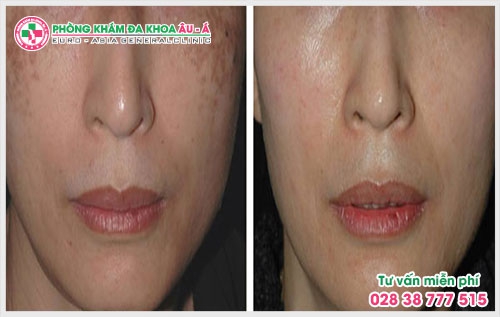 Việc hiểu được các tác nhân gây nên bệnh trị nám sẽ giúp mọi người có cách phòng tránh cũng như chữa trị bệnh tốt hơn