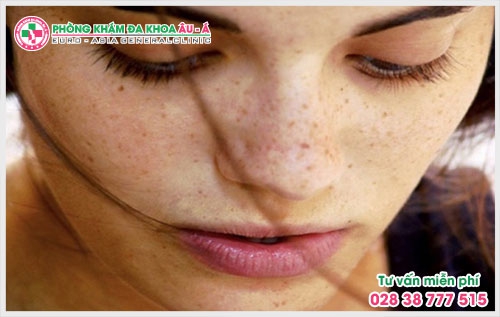 Xuất hiện các vết đốm li ti sẫm màu trên hai gò má là dấu hiệu triệu chứng bệnh trị nám da thường gặp