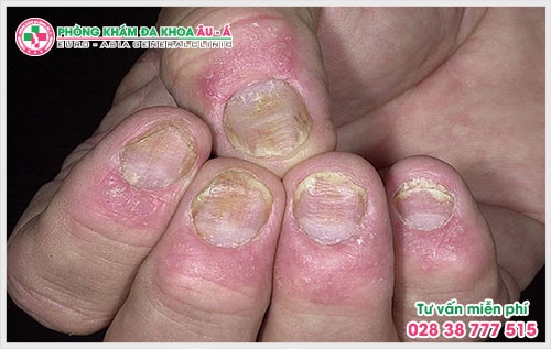 Bệnh vẩy nến ở móng tay có thể khắc phục được tình trạng của bệnh nếu như phát hiện sớm và được các bác sĩ giỏi hỗ trợ