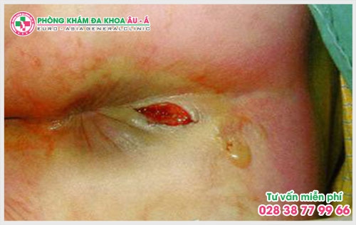 Vậy mổ rò hậu môn ở đâu tốt trên khu vực TP.HCM là một thắc mắc của nhiều bệnh nhân.
