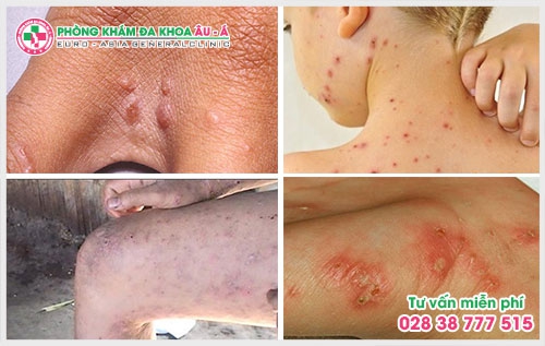 người bệnh nên tìm đến phòng khám chữa bệnh ghẻ để được các bác sĩ giỏi trực tiếp thăm khám và điều trị bệnh một cách nhanh chóng.