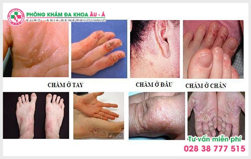 người bệnh nên tiến hành thăm khám sớm ở những phòng khám chữa bệnh chàm uy tín, chất lượng để được các bác sĩ chẩn đoán chính xác và đưa ra phác đồ điều trị phù hợp.