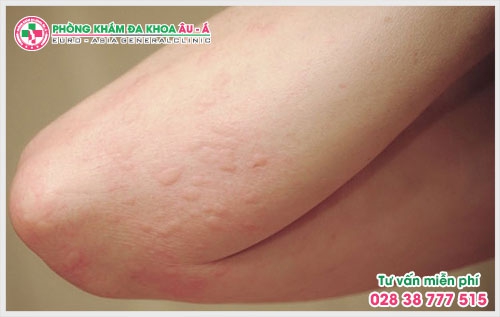 Việc tìm kiếm phòng khám chuyên khoa dị ứng da uy tín, chất lượng là mối quan tâm của nhiều bệnh nhân mắc bệnh về da