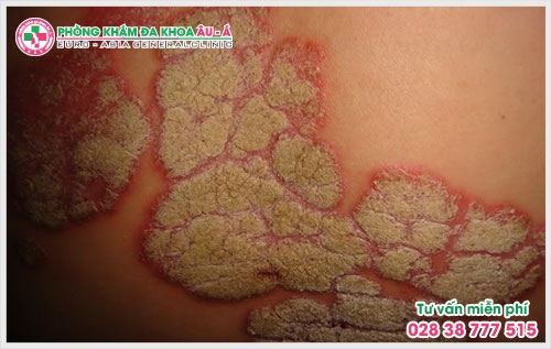 Theo các chuyên gia đầu ngành việc xác định đâu là phòng khám Vảy Nến chất lượng cần dựa vào nhiều tiêu chí khác nhau