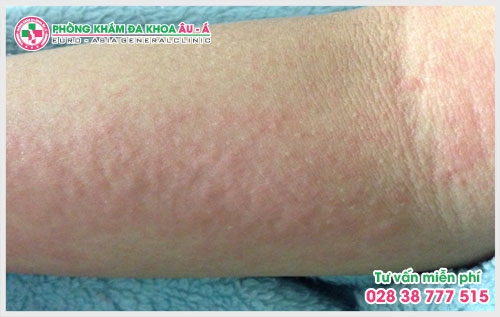 Phòng Khám Da liễu Âu Á đã trở thành địa chỉ khám chữa cũng như tư vấn da liễu đáng tin cậy cho mọi người ở TP.HCM và các khu vực lân cận.