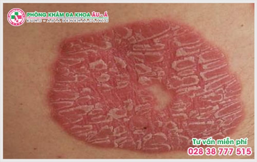 Phòng Khám Da liễu Âu Á đã trở thành địa chỉ khám chữa cũng như tư vấn da liễu đáng tin cậy cho mọi người ở TP.HCM và các khu vực lân cận.