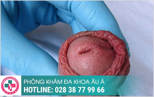 Một số hình ảnh trước và sau khi cắt bao quy đầu