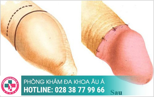 Một số hình ảnh trước và sau khi cắt bao quy đầu