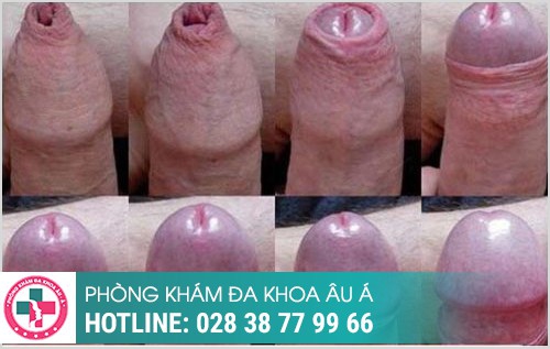 Một số hình ảnh trước và sau khi cắt bao quy đầu