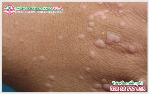 Tại khu vực TPHCM Da Liễu Âu Á là một trong những phòng khám chuyên khoa hạt cơm đáp ứng đầy đủ các tiêu chuẩn để trở thành một nơi điều trị chất lượng