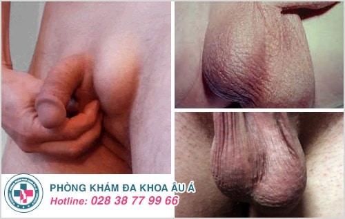 Tinh hoàn bị lệch do đâu? Có sao không? Tinh hoàn bị lệch do đâu? Có sao không?