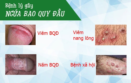 Tổng quan về hiện tượng ngứa bao quy đầu nam giới - cần lưu ý!